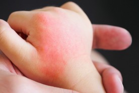 Patches of red, itchy skin, or heat rash on child's hand