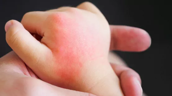 Patches of red, itchy skin, or heat rash on child's hand